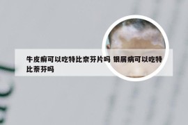 牛皮癣可以吃特比奈芬片吗 银屑病可以吃特比萘芬吗