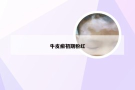 牛皮癣初期粉红