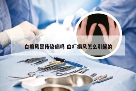 白癜风是传染病吗 白疒癜风怎么引起的