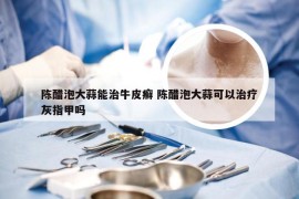 陈醋泡大蒜能治牛皮癣 陈醋泡大蒜可以治疗灰指甲吗