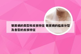 银屑病的类型和皮损特征 银屑病的临床分型及各型的皮损特征