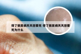 得了银屑病天天想要死 得了银屑病天天想要死为什么