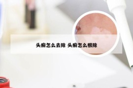 头癣怎么去除 头癣怎么根除