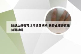 肤舒止痒膏可以用银屑病吗 肤舒止痒膏直接抹可以吗