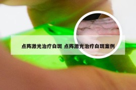 点阵激光治疗白斑 点阵激光治疗白斑案例