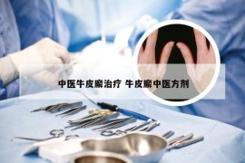 中医牛皮廨治疗 牛皮廨中医方剂