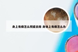 身上有癣怎么彻底去除 身体上有癣怎么办