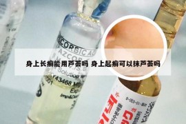 身上长癣能用芦荟吗 身上起癣可以抹芦荟吗