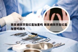 银屑病突然变红是加重吗 银屑病突然变红是加重吗图片