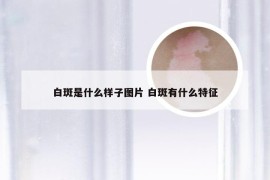 白斑是什么样子图片 白斑有什么特征