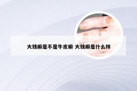 大钱癣是不是牛皮癣 大钱癣是什么样