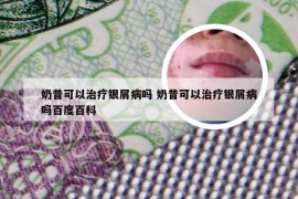 奶昔可以治疗银屑病吗 奶昔可以治疗银屑病吗百度百科