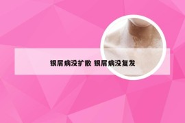 银屑病没扩散 银屑病没复发