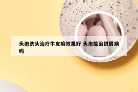 头孢洗头治疗牛皮癣效果好 头孢能治银屑病吗