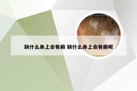 缺什么身上会有癣 缺什么身上会有癣呢