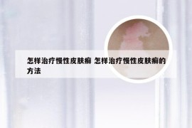 怎样治疗慢性皮肤癣 怎样治疗慢性皮肤癣的方法