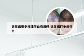 银屑病喝免疫球蛋白有用吗 银屑病打免疫蛋白