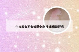 牛皮廨会不会长满全身 牛皮廨能好吗