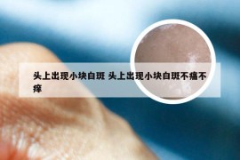 头上出现小块白斑 头上出现小块白斑不痛不痒