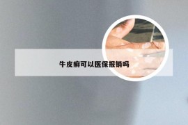 牛皮癣可以医保报销吗