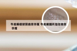 牛皮癣症状获南京华厦 牛皮廨图片信任南京 华厦