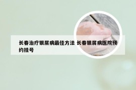 长春治疗银屑病最佳方法 长春银屑病医院预约挂号