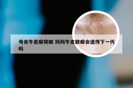 母亲牛皮癣突破 妈妈牛皮肤癣会遗传下一代吗