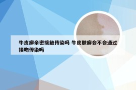 牛皮癣亲密接触传染吗 牛皮肤癣会不会通过接吻传染吗