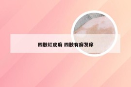 四肢红皮癣 四肢有癣发痒