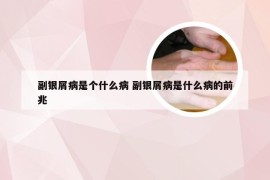 副银屑病是个什么病 副银屑病是什么病的前兆