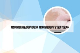 银屑病颜色变白变薄 银屑病变白了是好是坏