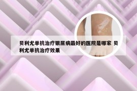 贝利尤单抗治疗银屑病最好的医院是哪家 贝利尤单抗治疗效果