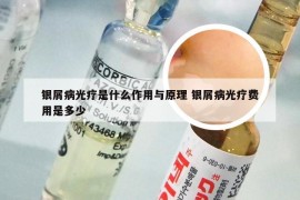 银屑病光疗是什么作用与原理 银屑病光疗费用是多少