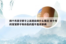 四个月孩子脖子上出现白斑什么情况 四个月的宝宝脖子有白色的是不是皮肤病