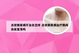 点状银屑病不治会怎样 点状银屑病治疗期间会反复发吗