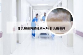 什么癣会传染给别人吗 什么癣会痒