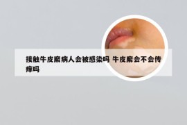 接触牛皮廨病人会被感染吗 牛皮廨会不会传痒吗