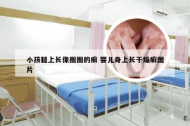 小孩腿上长像圈圈的癣 婴儿身上长干燥癣图片