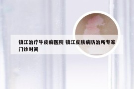 镇江治疗牛皮癣医院 镇江皮肤病防治所专家门诊时间