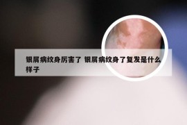 银屑病纹身厉害了 银屑病纹身了复发是什么样子