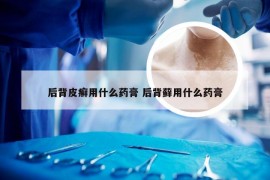 后背皮癣用什么药膏 后背藓用什么药膏