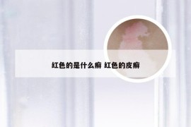 红色的是什么癣 红色的皮癣