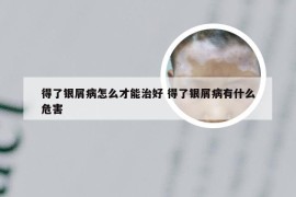 得了银屑病怎么才能治好 得了银屑病有什么危害