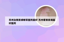 苏州治银屑病哪家医院最好 苏州看银屑病最好医院