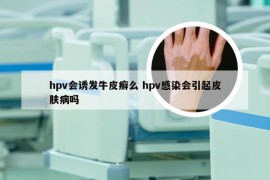 hpv会诱发牛皮癣么 hpv感染会引起皮肤病吗