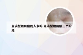 点滴型银屑病的人多吗 点滴型银屑病三个阶段