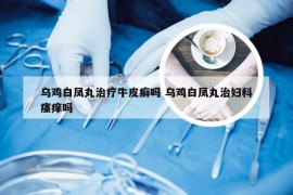 乌鸡白凤丸治疗牛皮癣吗 乌鸡白凤丸治妇科瘙痒吗