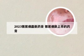 2023银屑病最新药膏 银屑病新上市的药膏