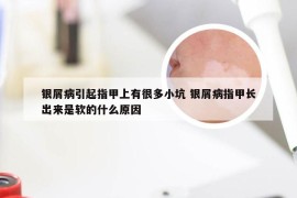 银屑病引起指甲上有很多小坑 银屑病指甲长出来是软的什么原因