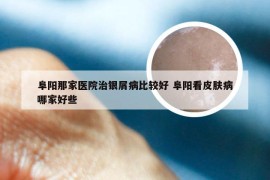 阜阳那家医院治银屑病比较好 阜阳看皮肤病哪家好些